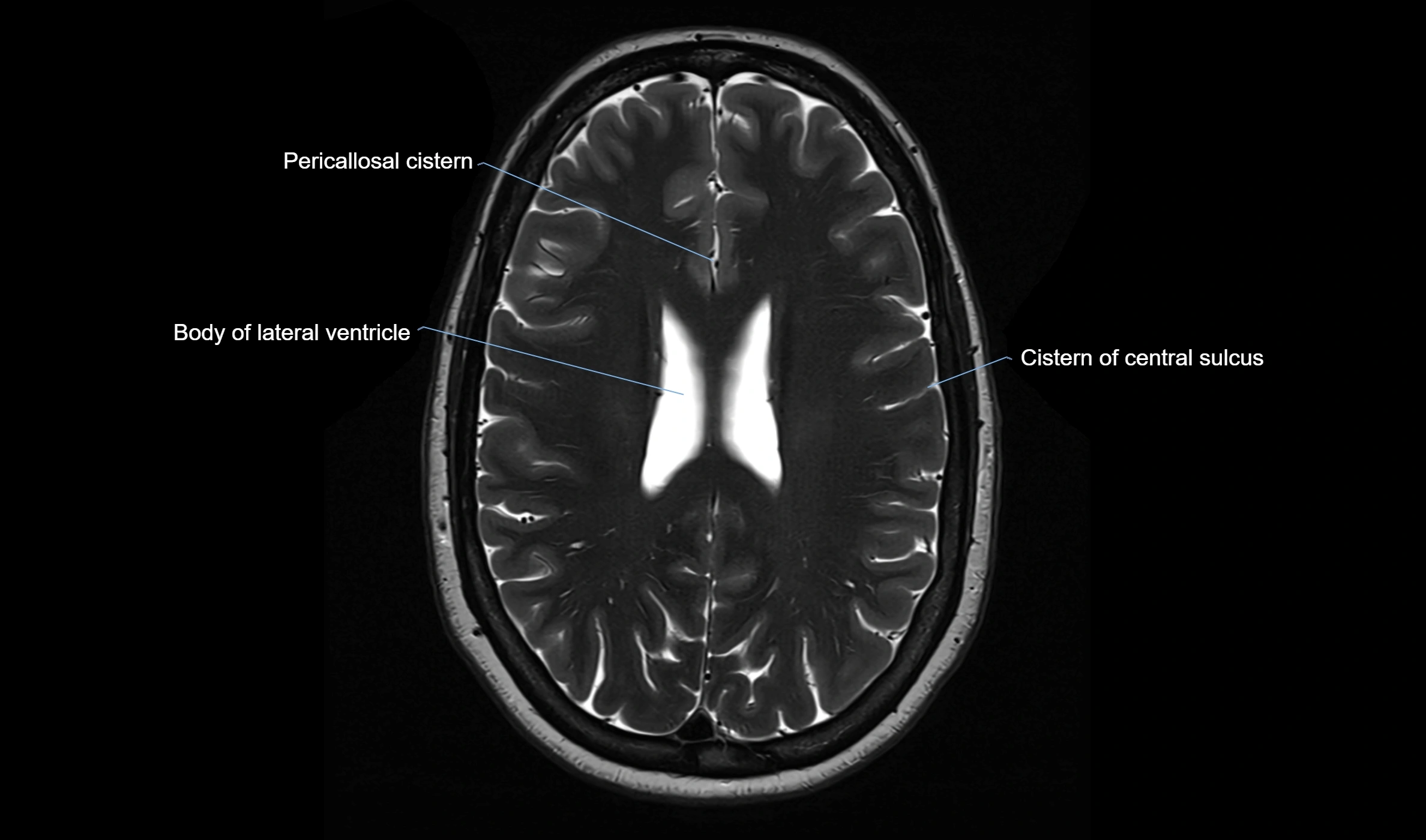 Brain cisterns  and ventricles  axial anatomy 3T MRI image-img-00001-00037.webp